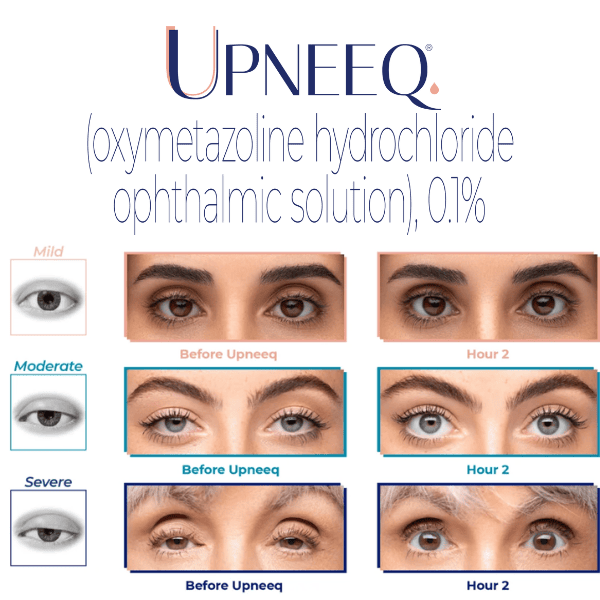 Upneeq Eye Drops