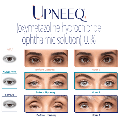 Upneeq Eye Drops